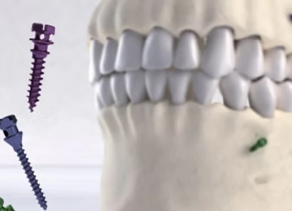 Module 4 - L'ancrage. Formation pour les orthodontistes, disponible à Lille (OLIO) et à Bruxelles (OBIO). Créé par Dr Emmanuël Bocquet
